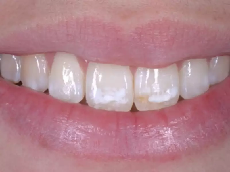 Does Well Water Cause Teeth Staining? Fluoride, Well Water, and Oral Health